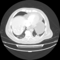 Acute heart failure (CT) (Radiopaedia 79835-93075 Axial lung window 37).png