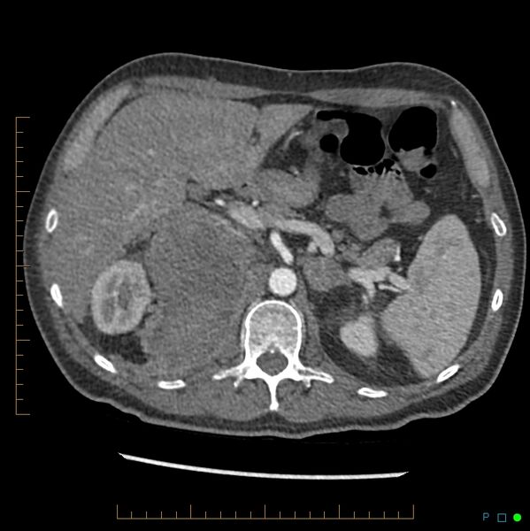File:Acute hemorrhage into adrenal metastasis from NSCLC (Radiopaedia 43135-46429 Axial C+ arterial phase 8).jpg