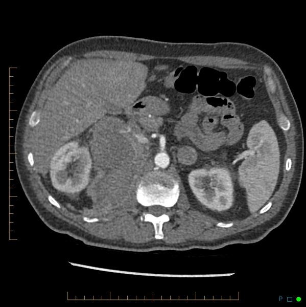 File:Acute hemorrhage into adrenal metastasis from NSCLC (Radiopaedia 43135-46429 Axial C+ arterial phase 9).jpg