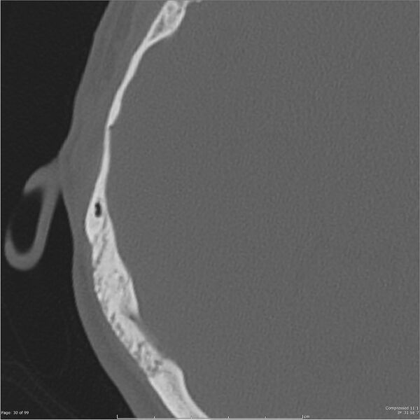 File:Acute otomastoiditis (Radiopaedia 28276-28512 Axial PTB bone window reformat 10).jpg