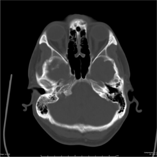File:Acute otomastoiditis (Radiopaedia 28276-28512 Axial bone window 6).jpg