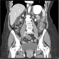 Acute pancreatitis (Radiopaedia 19136-19117 Coronal C+ portal venous phase 24).jpg