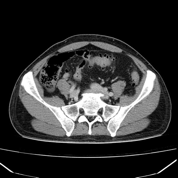 File:Acute pancreatitis (Radiopaedia 22572-22596 Axial C+ portal venous phase 54).jpg