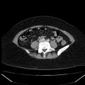 Acute pancreatitis - Balthazar C (Radiopaedia 26569-26714 Axial C+ portal venous phase 65).jpg