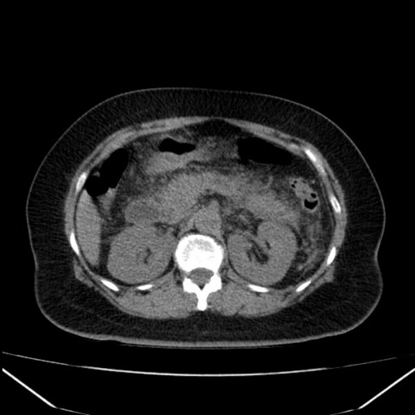 File:Acute pancreatitis - Balthazar C (Radiopaedia 26569-26714 Axial non-contrast 36).jpg