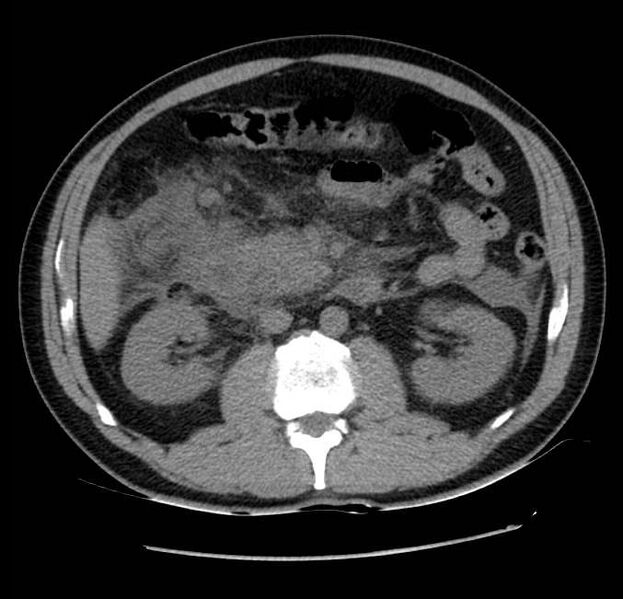File:Acute pancreatitis - Balthazar E (Radiopaedia 23080-23110 Axial non-contrast 31).jpg