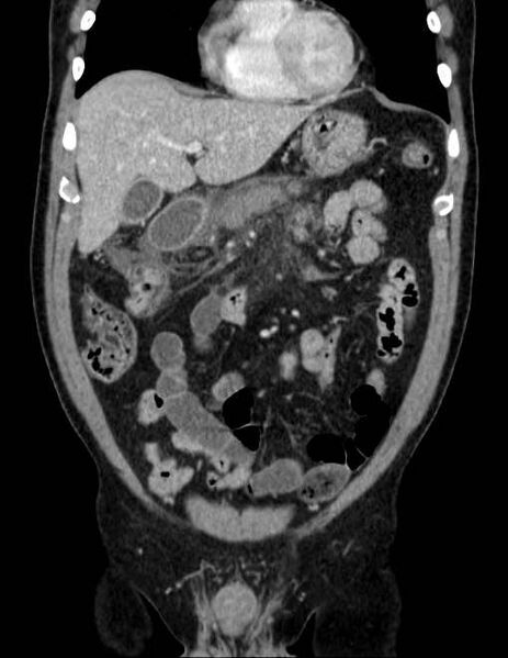File:Acute pancreatitis - Balthazar E (Radiopaedia 23080-23110 Coronal C+ portal venous phase 23).jpg