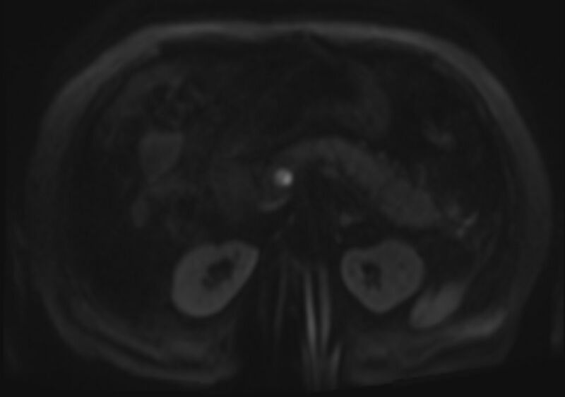 File:Acute portal vein thrombosis (Radiopaedia 73198-83925 Axial DWI 77).jpg