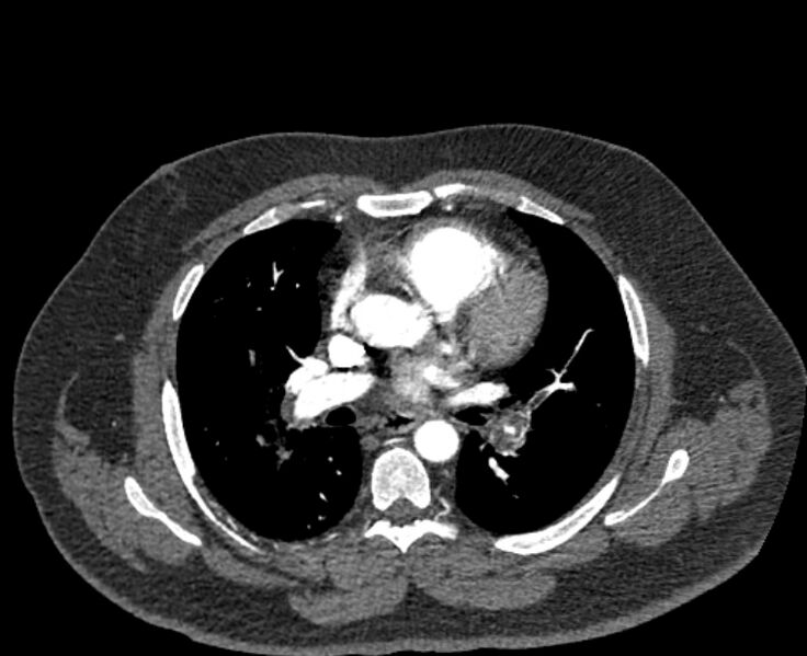 File:Acute pulmonary embolism with pulmonary infarcts (Radiopaedia 77688-89908 Axial C+ CTPA 30).jpg