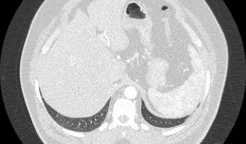 Acute pulmonary embolism with pulmonary infarcts (Radiopaedia 77688-89908 Axial lung window 131).jpg