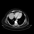 Acute pyelonephritis (Radiopaedia 25657-25837 Axial renal parenchymal phase 8).jpg