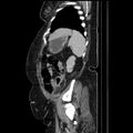 Acute pyelonephritis (Radiopaedia 25657-25837 Sagittal renal parenchymal phase 63).jpg
