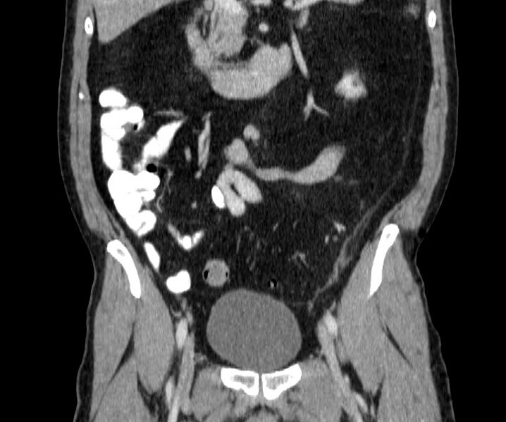 File:Acute sigmoid colon diverticulitis (Radiopaedia 55507-61976 Coronal C+ portal venous phase 70).jpg
