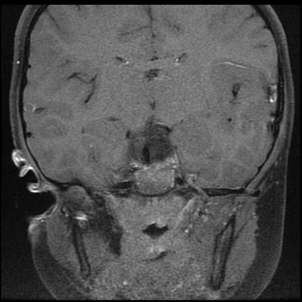 File:Adamantinomatous craniopharyngioma (Radiopaedia 77407-89529 Coronal T1 C+ fat sat 10).jpg