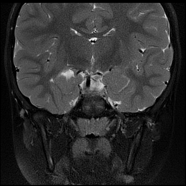 File:Adamantinomatous craniopharyngioma (Radiopaedia 77407-89529 Coronal T2 fat sat 9).jpg