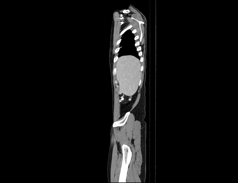 File:Addison disease (Radiopaedia 49318-54412 Sagittal C+ portal venous phase 61).jpg