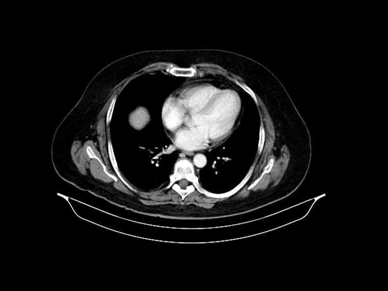 File:Adenocarcinoma of pancreas with hepatic metastasis (Radiopaedia 64332-73122 Axial C+ portal venous phase 9).jpg