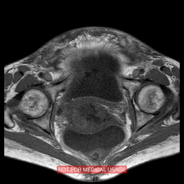 File:Adenocarcinoma of the cervix (Radiopaedia 28373-28615 Axial T1 8).jpg