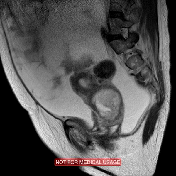 File:Adenocarcinoma of the cervix (Radiopaedia 28373-28615 Sagittal T2 11).jpg