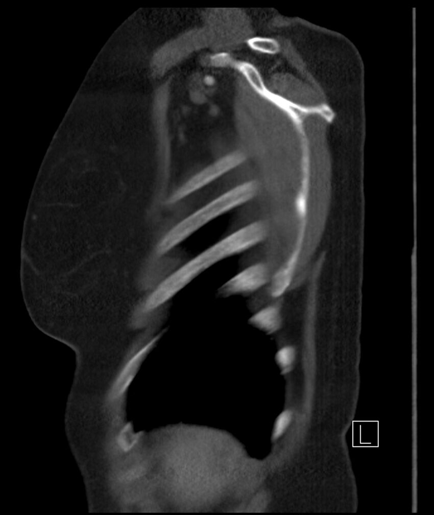 Adenocarcinoma of the lung (Radiopaedia 44205-47803 Sagittal C+ portal venous phase 5).jpg