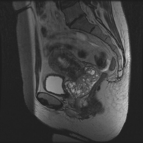 File:Adenoma malignum of the cervix (Radiopaedia 24460-24765 T2 65).jpg
