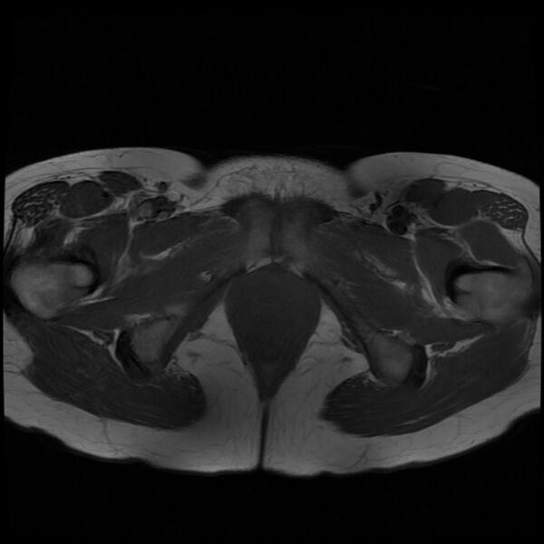 File:Adenomyosis on MRI (Radiopaedia 29328-29780 Axial T1 12).jpg