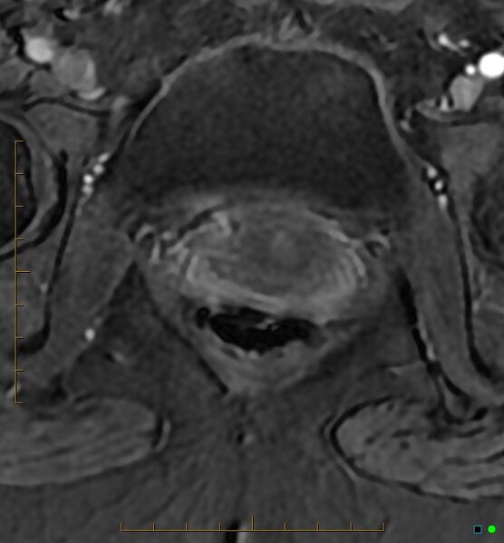 File:Adenomyosis uterus with hematometra (Radiopaedia 45779-50011 Axial T1 C+ fat sat 57).jpg