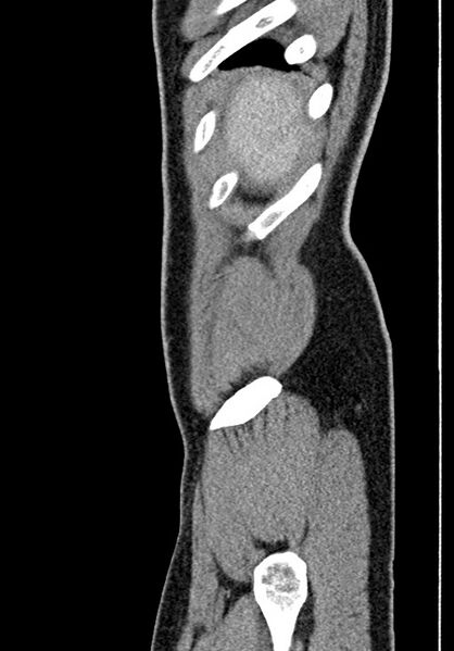 File:Adhesional small bowel obstruction (Radiopaedia 58900-66131 Sagittal C+ portal venous phase 19).jpg