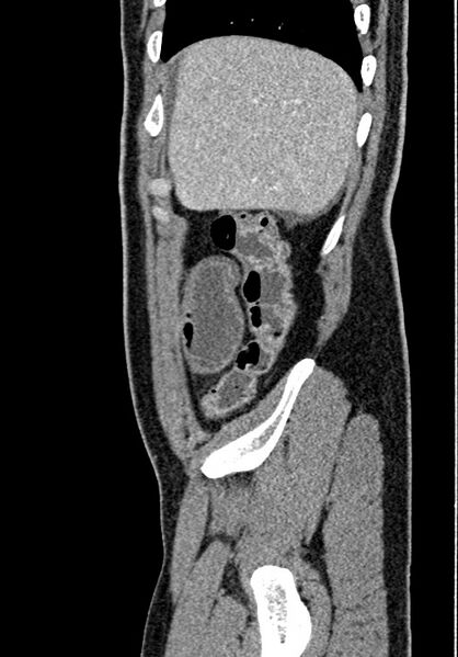 File:Adhesional small bowel obstruction (Radiopaedia 58900-66131 Sagittal C+ portal venous phase 39).jpg