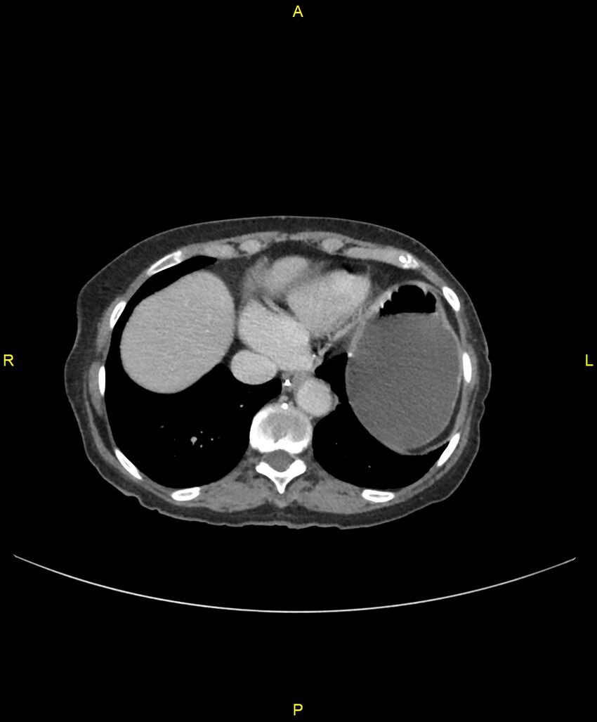 Adhesional small bowel obstruction (Radiopaedia 85402-101024 Axial C+ portal venous phase 28).jpg