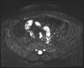 Adnexal multilocular cyst (O-RADS US 3- O-RADS MRI 3) (Radiopaedia 87426-103754 Axial DWI 4).jpg