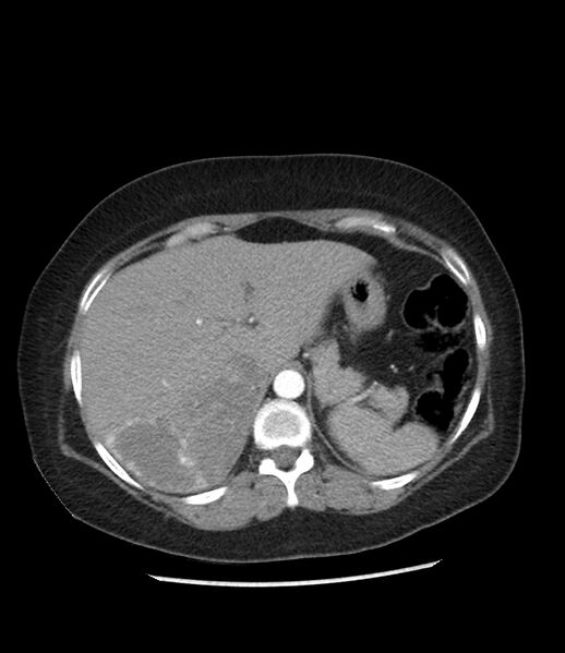 File:Adrenal cortical carcinoma with IVC invasion and thrombosis (Radiopaedia 34307-35597 Axial C+ arterial phase 20).jpg