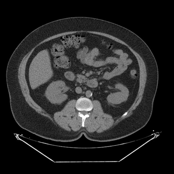 File:Adrenal myelolipoma (Radiopaedia 26278-26407 Axial non-contrast 30).jpg