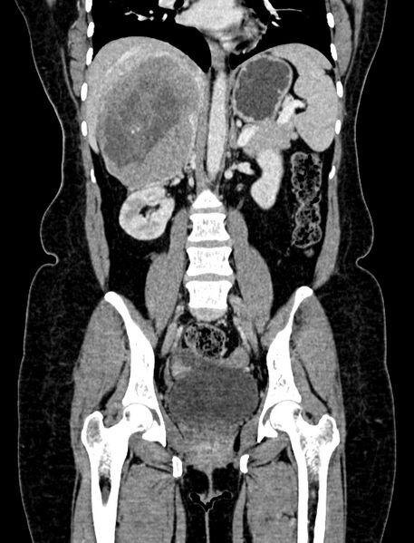 File:Adrenocortical carcinoma (Radiopaedia 87281-103569 Coronal C+ portal venous phase 64).jpg