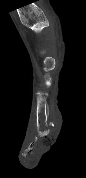 File:Advanced osteomyelitis due to open metatarsal fracture (Radiopaedia 83891-99095 C 4).jpg