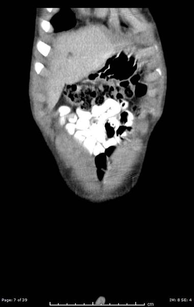 File:Agenesis of the gallbladder (Radiopaedia 55454-61905 A 7).jpg