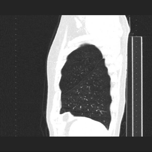 File:Allergic bronchopulmonary aspergillosis (Radiopaedia 21386-21320 Sagittal lung window 2).jpg