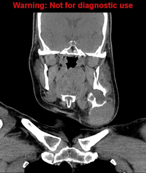 File:Ameloblastoma (Radiopaedia 33126-34164 D 36).jpg