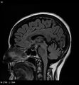 Amyotrophic lateral sclerosis (Radiopaedia 5373-7134 Sagittal FLAIR 12).jpg