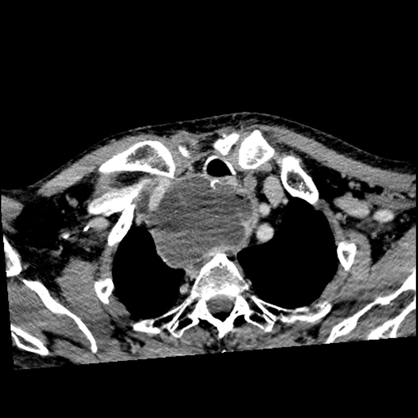 Anaplastic thyroid carcinoma (Radiopaedia 79087-92034 B 26).jpg