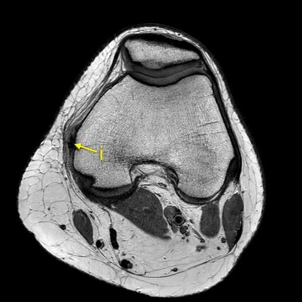 File:Anatomy Quiz (MRI knee) (Radiopaedia 43478-46866 A 10).jpeg