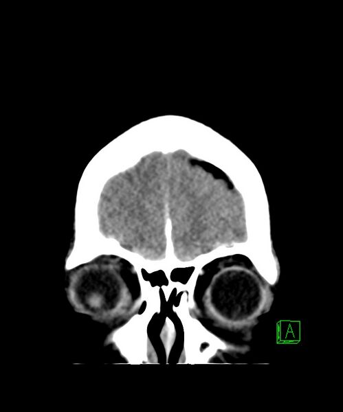 File:Angiomatous meningioma (Radiopaedia 79459-92578 Coronal non-contrast 6).jpg