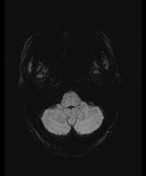 File:Angiomatous meningioma (Radiopaedia 79459-92579 E 7).jpg