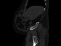 Ankylosing spondylitis (Radiopaedia 44609-48357 Sagittal bone window 13).jpg