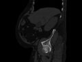 Ankylosing spondylitis (Radiopaedia 44609-48357 Sagittal bone window 21).jpg