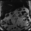Annular pancreas (Radiopaedia 38292-40320 Coronal T2 22).png