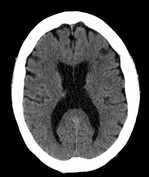 File:Anomalous intracranial venous drainage (Radiopaedia 28161-28418 Axial 24).png