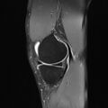 Anterior cruciate ligament full thickness tear (Radiopaedia 66268-75467 Sagittal PD fat sat 7).jpg
