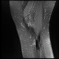 Anterior cruciate ligament tear, Wrisberg rip and bucket-handle tear of medial meniscus (Radiopaedia 75872-87266 Sagittal PD fat sat 1).jpg