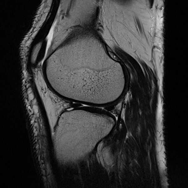 File:Anterior cruciate ligament tear - ramp lesion (Radiopaedia 71883-82322 Sagittal T2 8).jpg